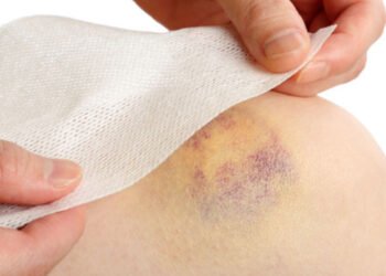 The Little-Known Nutrients That Protect Your Skin From Surgery Bruises