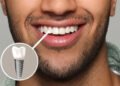 Experience Modern Implant Dentistry Performed by Trusted Dental Professionals in Downtown Vancouver