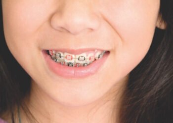 How Personalized Braces Plans Improve Orthodontic Results in Alpharetta
