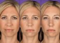 The Role Of Botox in Vancouver For Frown Line Reduction