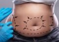 6 things to consider before undergoing a tummy tuck procedure