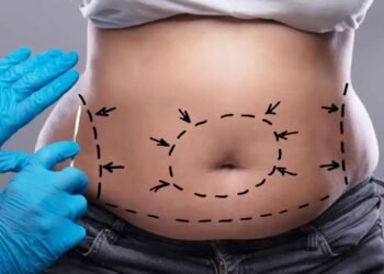 6 things to consider before undergoing a tummy tuck procedure