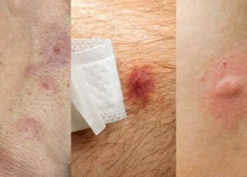 mosquitoes-vs-bed-bugs-how-to-tell-the-difference-1