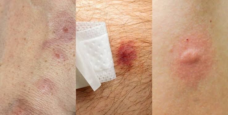 mosquitoes-vs-bed-bugs-how-to-tell-the-difference-1